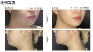サーマジェンEVO 症例写真（メーカー提供）：高周波RFによるフェイスラインの変化