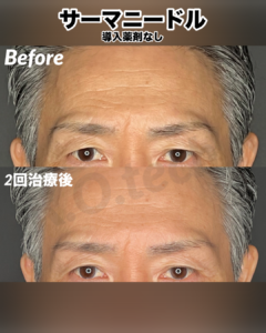 サーマニードルEvo 症例写真（メーカー提供）美肌モード：毛穴・凹凸の改善例