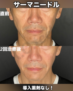 サーマニードルEvo 症例写真（メーカー提供）美肌モード：毛穴・肌質の変化