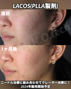 サーマニードルEvo 症例写真（メーカー提供）美肌モード：肌質改善の例