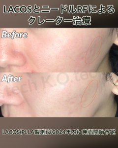 サーマニードルEvo 症例写真（メーカー提供）美肌モード：ニキビ跡・凹凸の例