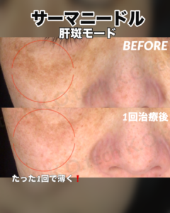 サーマニードルEvo 症例写真（メーカー提供）肝斑モード：もやもやしたシミの変化