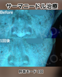 サーマニードルEvo 症例写真（メーカー提供）肝斑モード：肝斑の変化