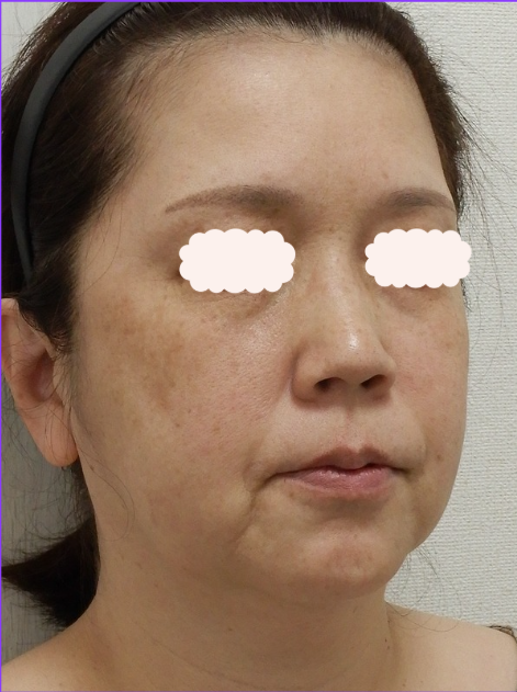 症例2 ヒアルロン酸注射 横顔 施術前