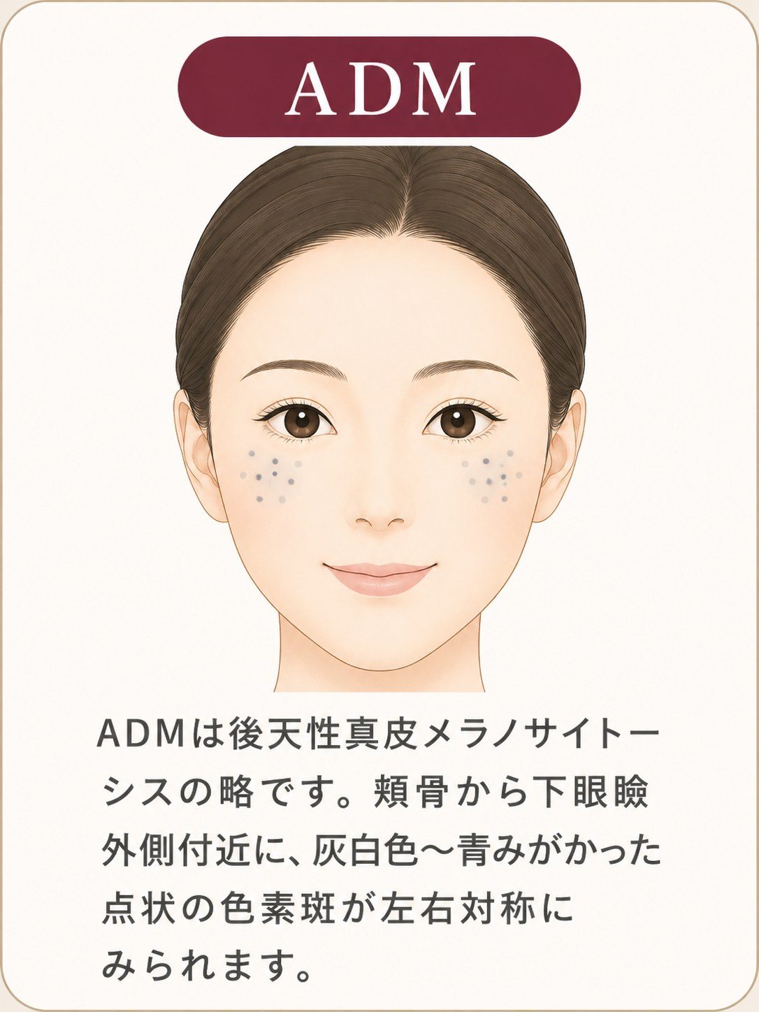 ADMは頬骨のあたりに青っぽい、灰色っぽいシミとして見えることがある説明図