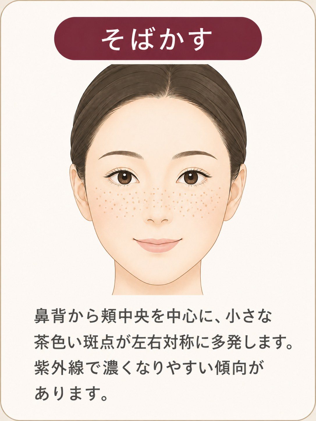 そばかすは鼻背から頬中央に小さな茶色い斑点が多発する説明図