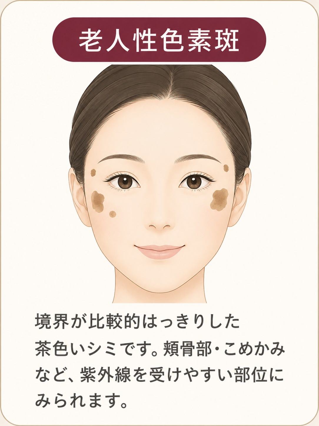 老人性色素斑は境界が比較的はっきりした茶色いシミとして見える説明図
