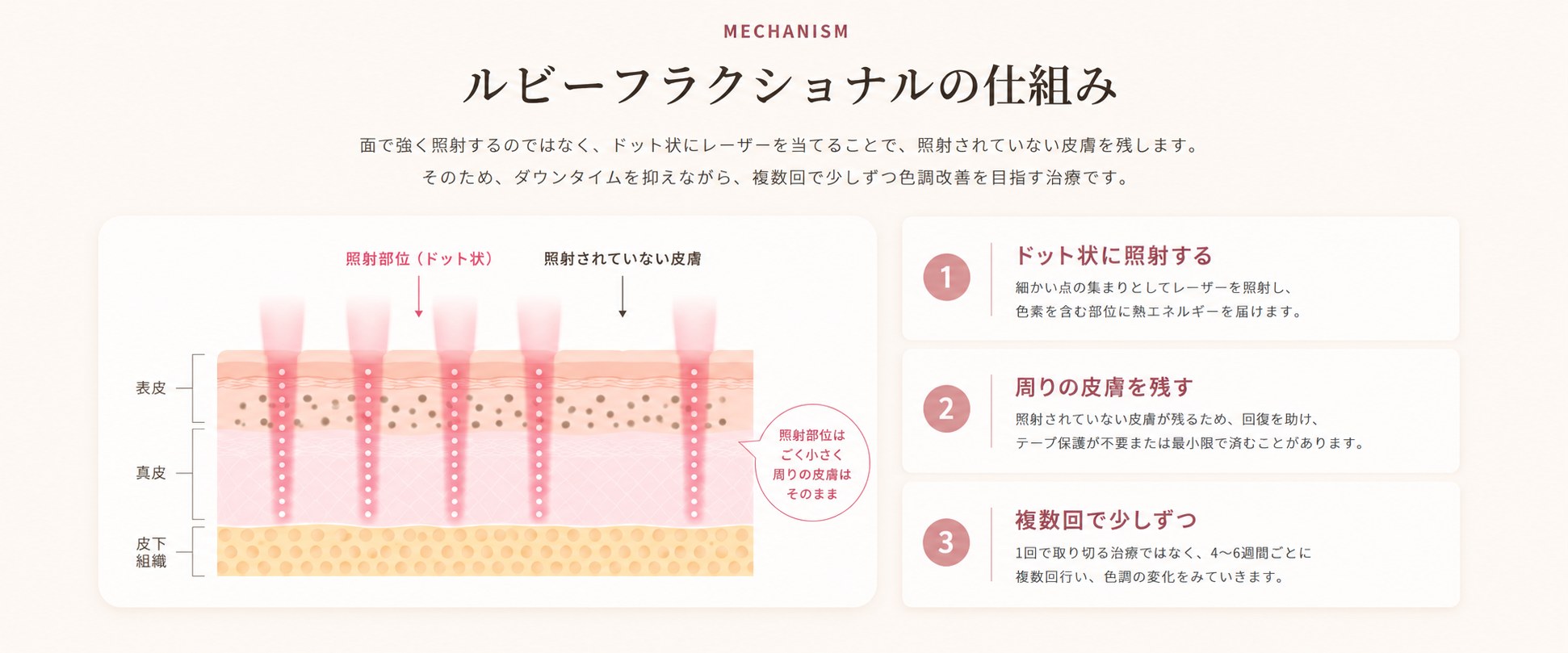 ルビーフラクショナルの仕組み。点状に照射し、照射されていない皮膚を残す説明図