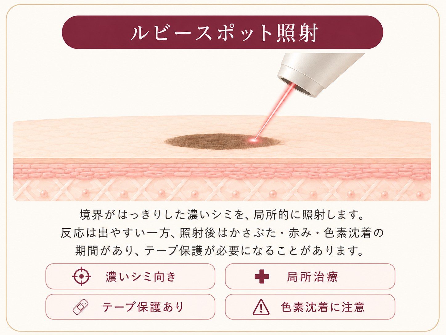 ルビースポット照射は境界がはっきりした濃いシミを局所的に照射する説明図