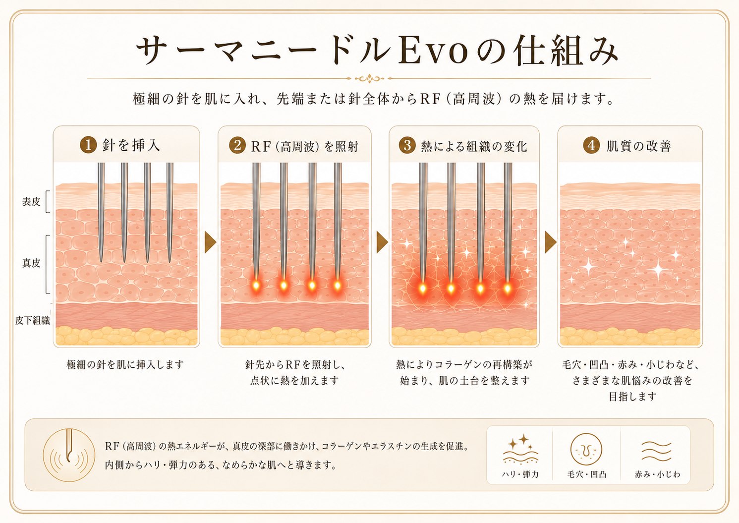 京都府向日市のサーマニードルEvo（RFマイクロニードル）｜毛穴・赤み