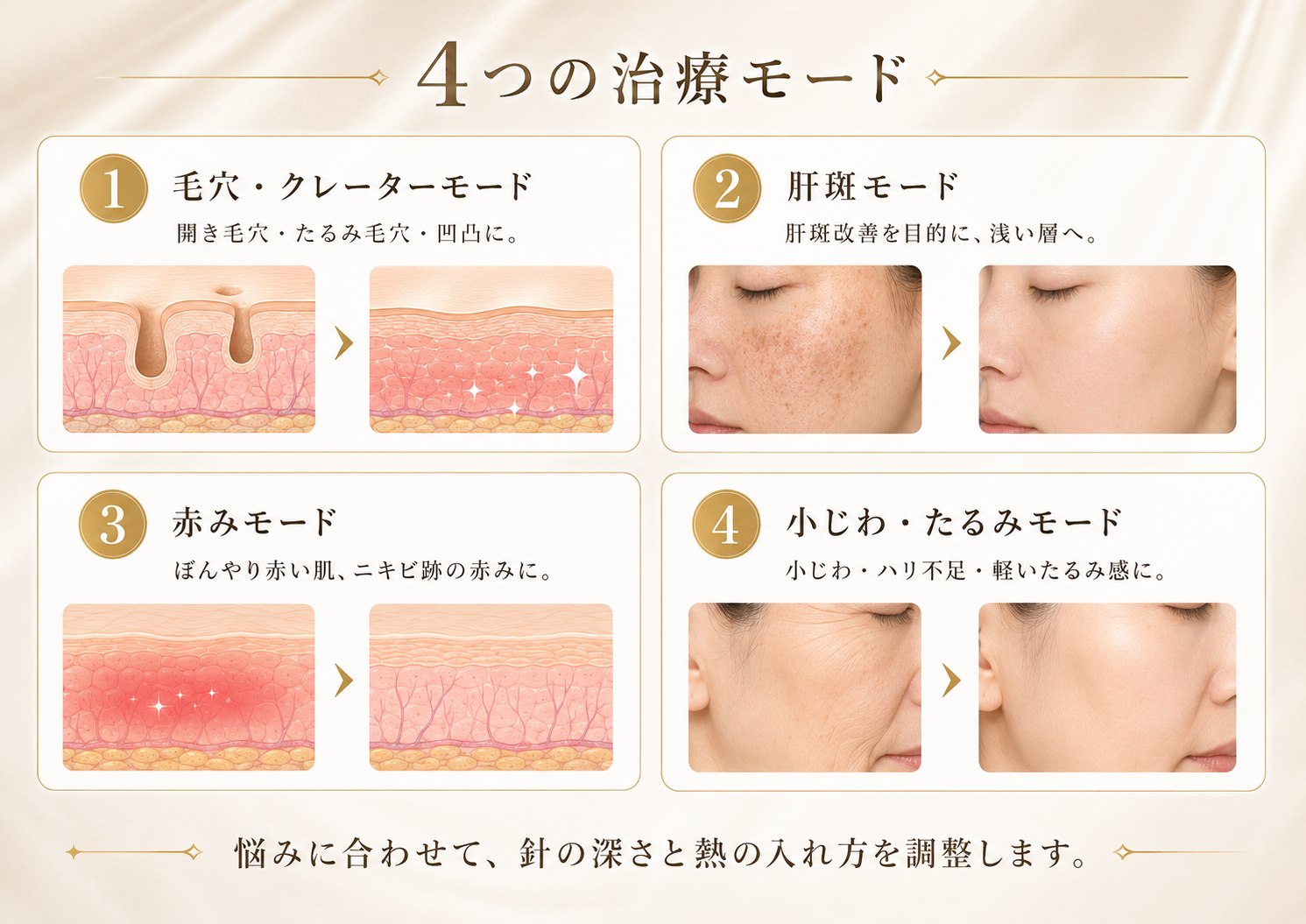 毛穴・クレーター、肝斑、赤み、小じわ・たるみの4つの治療モード