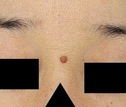 額の盛り上がったホクロに対するブルーレーザー処置前・正面拡大
