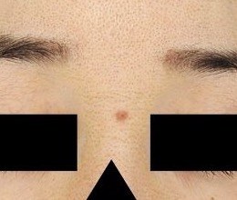 額の盛り上がったホクロに対するブルーレーザー処置1か月後・正面拡大