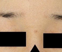 額の盛り上がったホクロに対するブルーレーザー処置3か月後・正面拡大