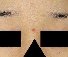 額の盛り上がったホクロに対するブルーレーザー処置1週間後・正面拡大